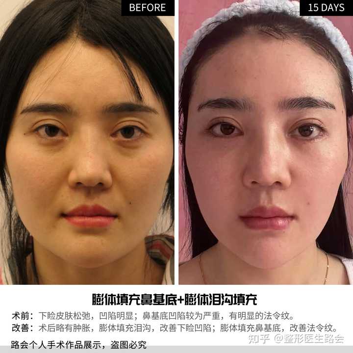面部凹陷怎么办? - 知乎