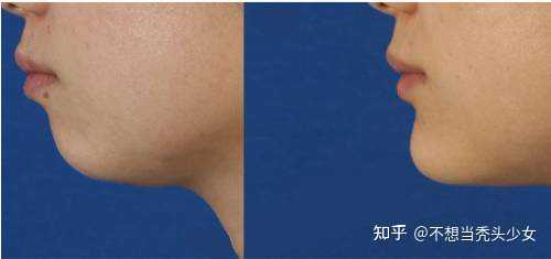 下巴后缩,正面挺好看侧面像个山顶洞人怎么办？ - 知乎