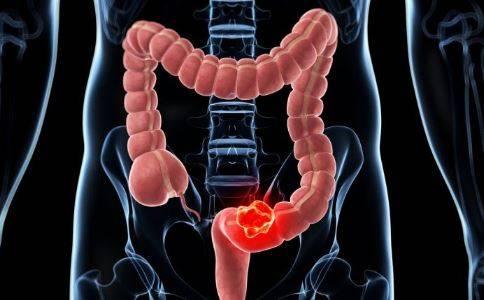 便血不一定是痔疮也有可能是直肠癌