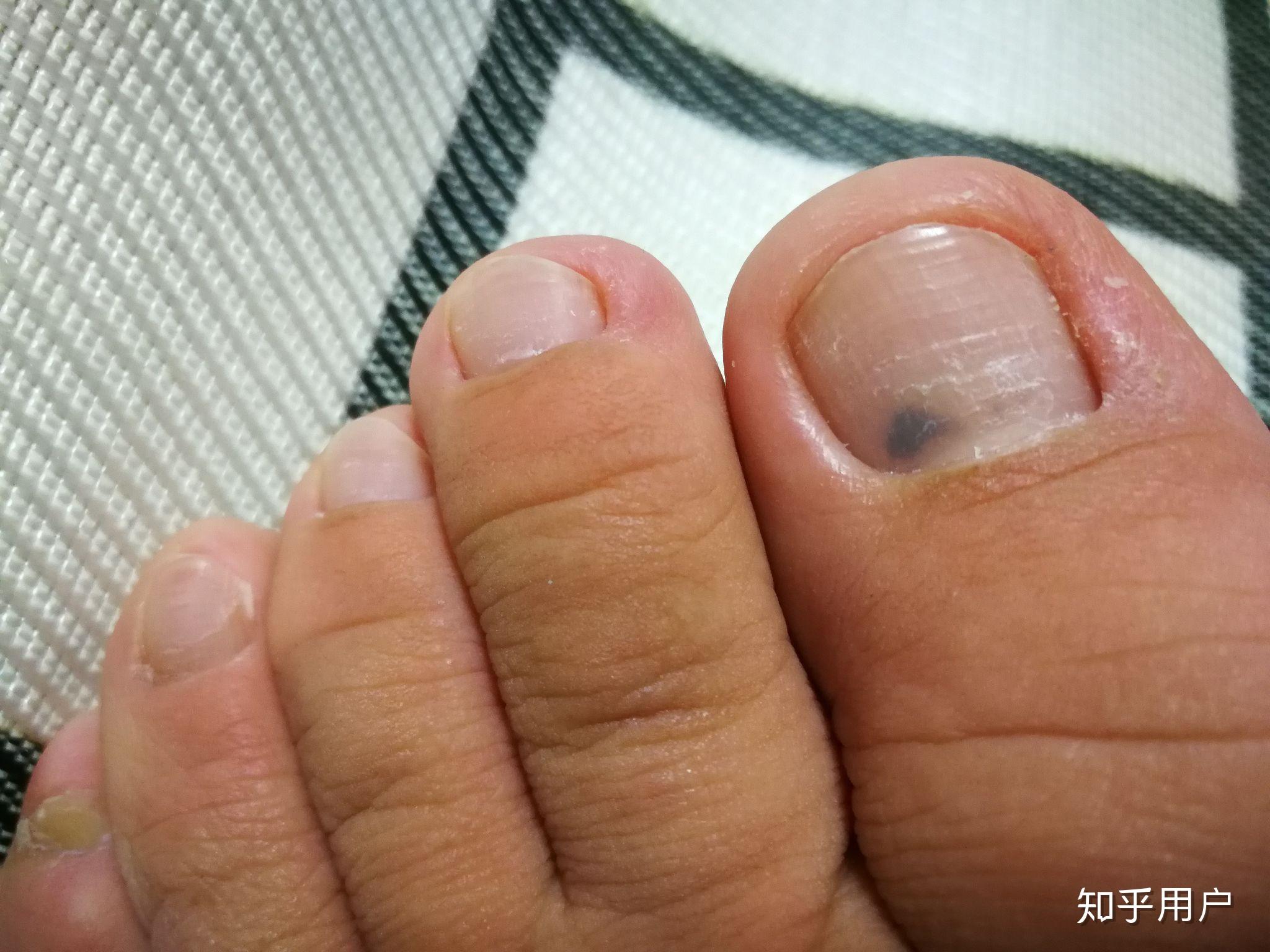 脚趾甲里出现一黑点是怎么回事? - 知乎