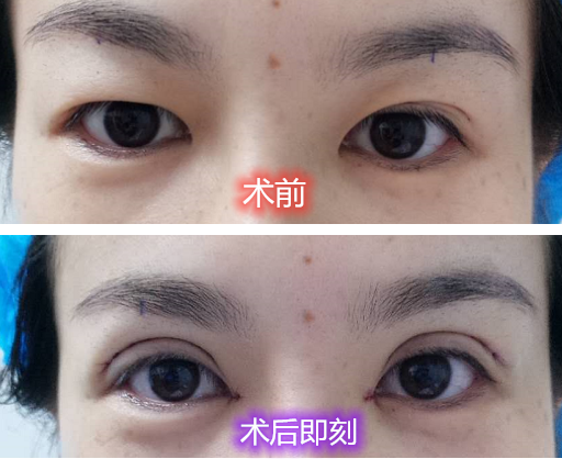 眼下皮肤松弛怎么办 知乎