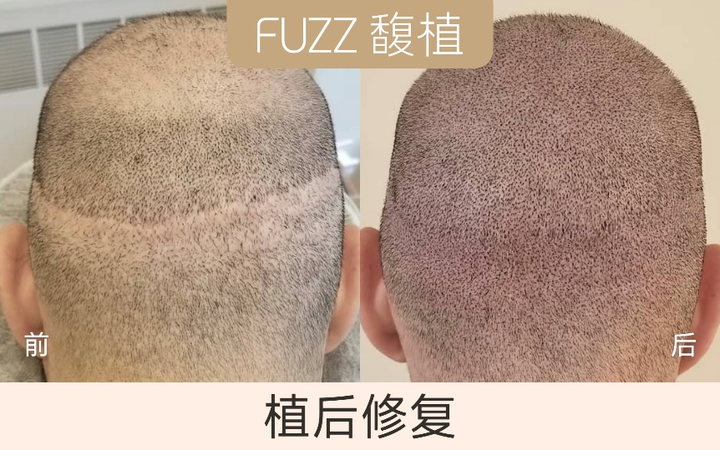 纹发是什么意思？纹发后要注意什么？ - 知乎