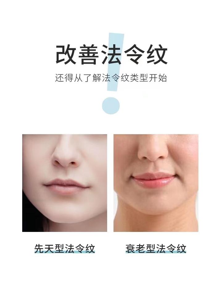 拉皮手术中怎么去除法令纹? - 知乎