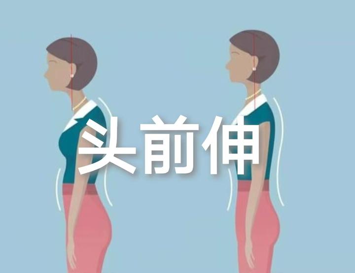 如何改善头前伸（猥琐颈）？ - 知乎