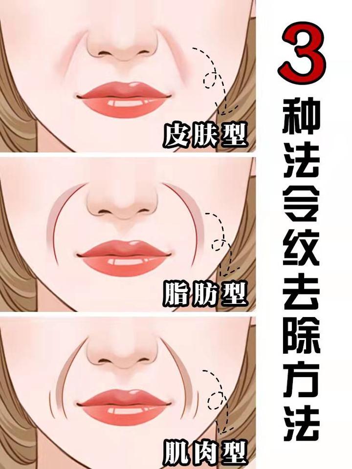 消除法令纹刻不容缓! - 知乎