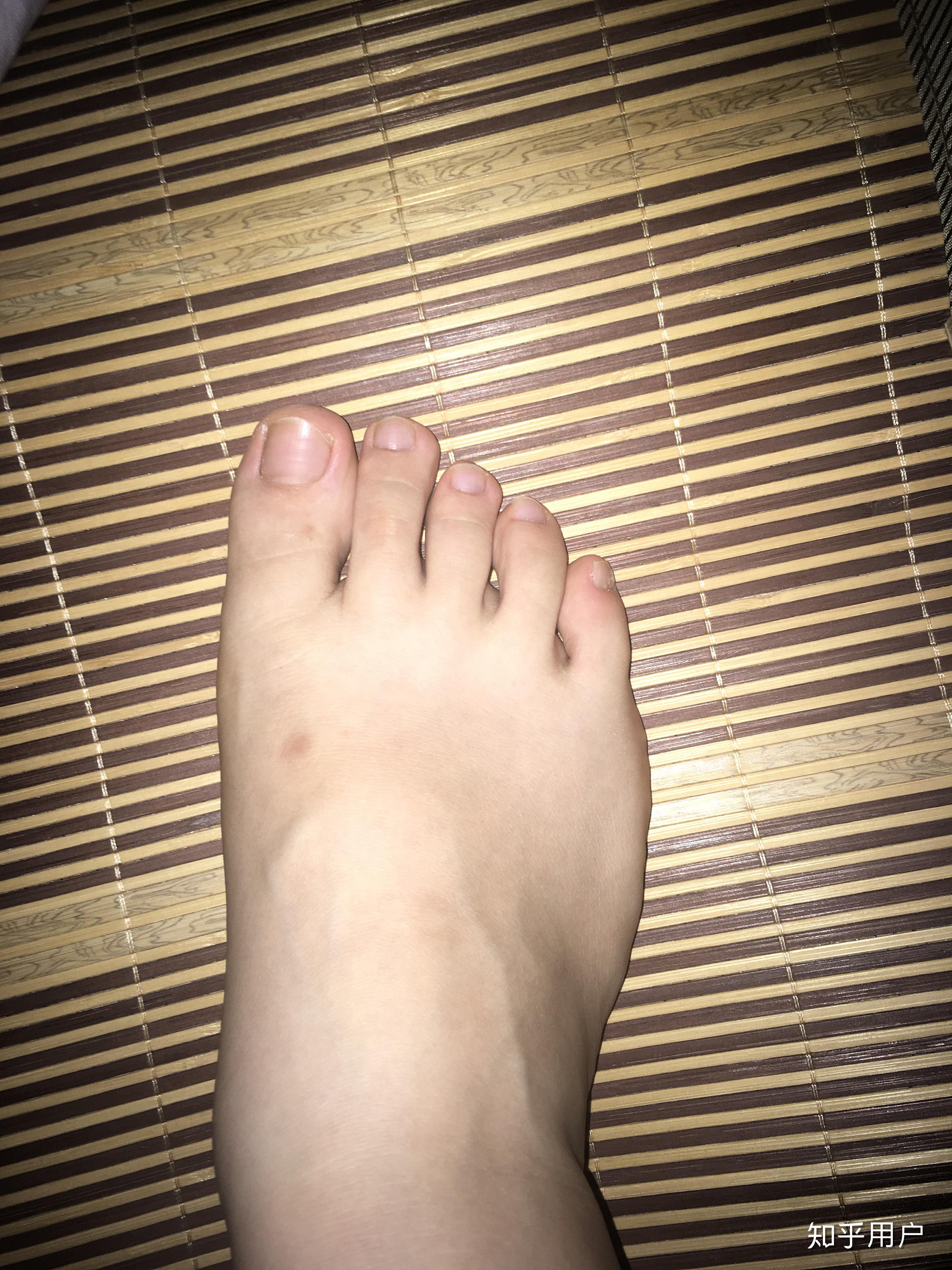 脚型太宽小拇脚趾外翻怎么办有什么解决办法吗